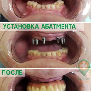 Протезирование на имплантах - доктор Бонданец А. Ю.