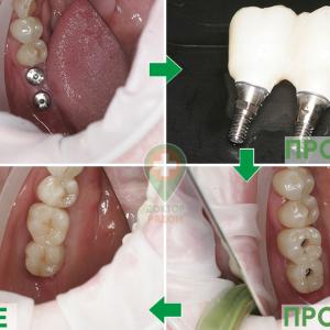 Имплантация зубов - доктор Зенкевич Ю. В. 