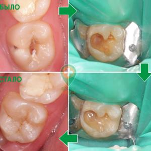 Лечение кариеса, установка пломбы - доктор Петюн Е. Э.