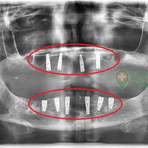 Имплантация при адентии. Установка 10 имплантов пациенту 54 лет.