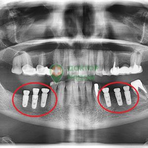 Установка 6 имплантов. Пациентка, 49 лет.