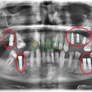 Установка 7 имплантов под ключ пациенту 58 лет. 