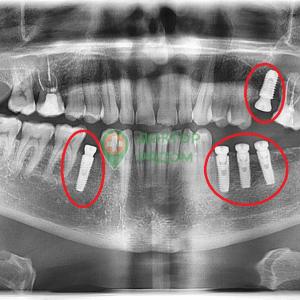 Пациент обратился для восстановления зубного ряда. Установлены 5 имплантов. 