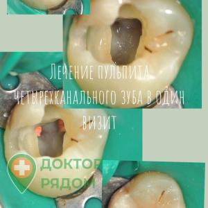 Доктор Лавренюк: лечение пульпита четырехканального зуба в один визит