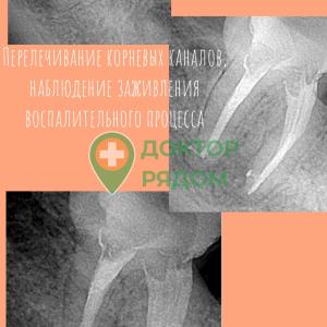 Доктор Лавренюк: перелечивание корневых каналов, наблюдение заживления воспалительного процесса