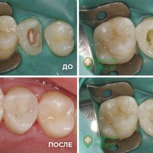 Постэндодонтическое лечение, реставрация - доктор Корзун Н. Ю.