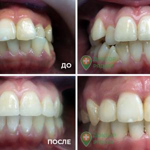 После ортодонтического лечения и эстетических реставраций