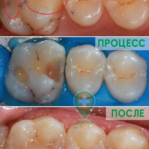 Установка пломбы, эстетическая реставрация - доктор Корзун Н.Ю. 