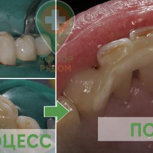 Шинирование зубов доктором Петюн Е. Э.