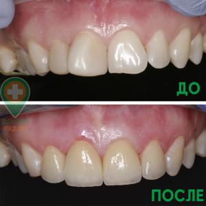 Установка виниров (безметалловых конструкций) в стоматологии Доктор Рядом