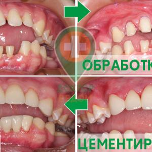 Установка виниров (безметалловых конструкций) в стоматологии Доктор Рядом