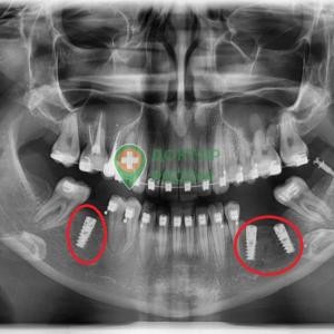 Установка трех имплантов молодой пациентке с брекетами