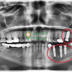Установка четырех имплантов пациенту 53 лет
