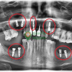 Установка восьми имплантов под ключ - пациент 62 лет